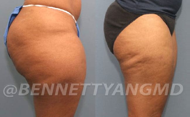 thigh-before_after-4a