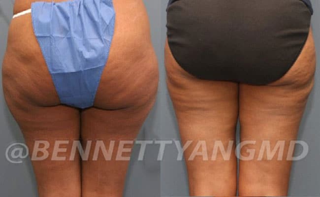 thigh-before_after-6a