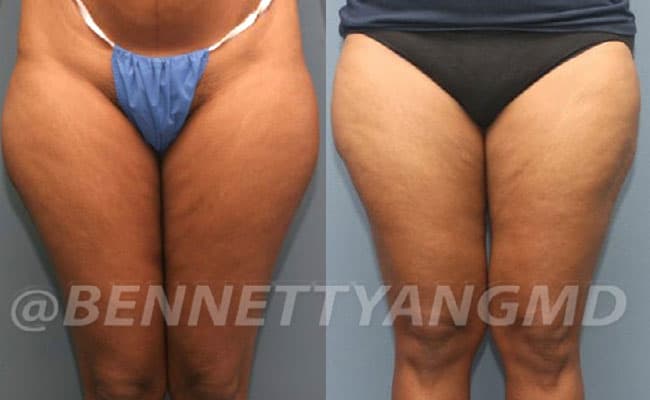 thigh-before_after-7a