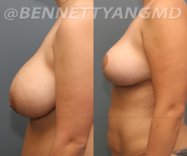 BBL Maryland Plastic Surgeon Bennett C. Yang