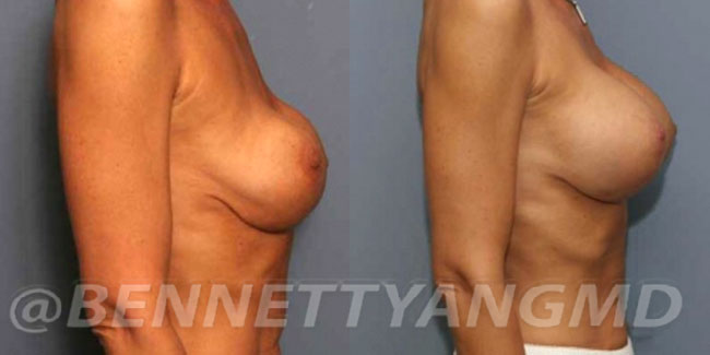 thumbs_implant-correction-before-after_2t