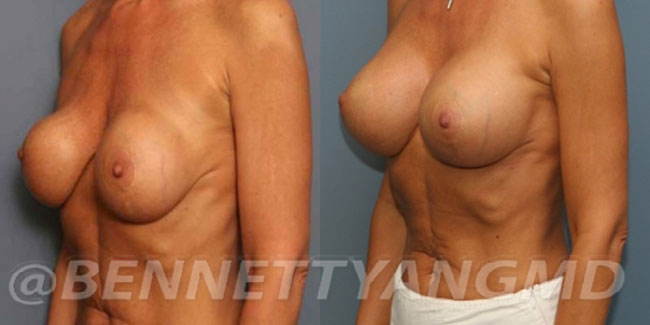 thumbs_implant-correction-before-after_2w