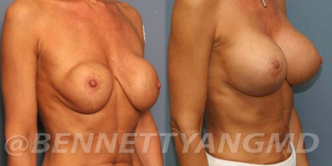 thumbs_implant-correction-before-after_2wt