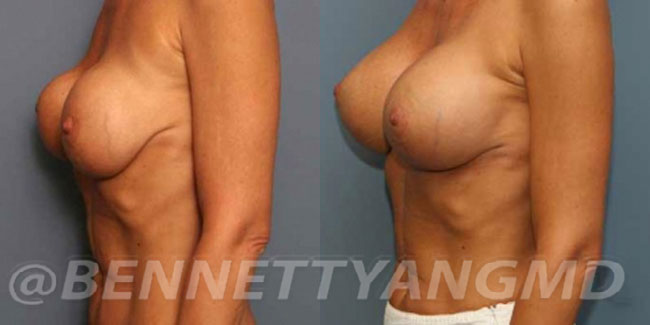thumbs_implant-correction-before-after_2y