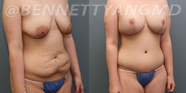 thumbs_liposuction-before_after-3o