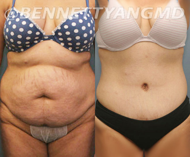 BBL Maryland Plastic Surgeon Bennett C. Yang