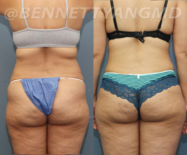 https://www.bennettyangmd.com/wp-content/uploads/2019/08/tummy-tuck-pt35-begore-after-43a.jpg