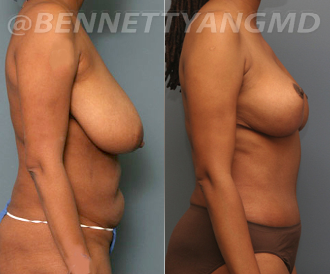 BBL Maryland Plastic Surgeon Bennett C. Yang