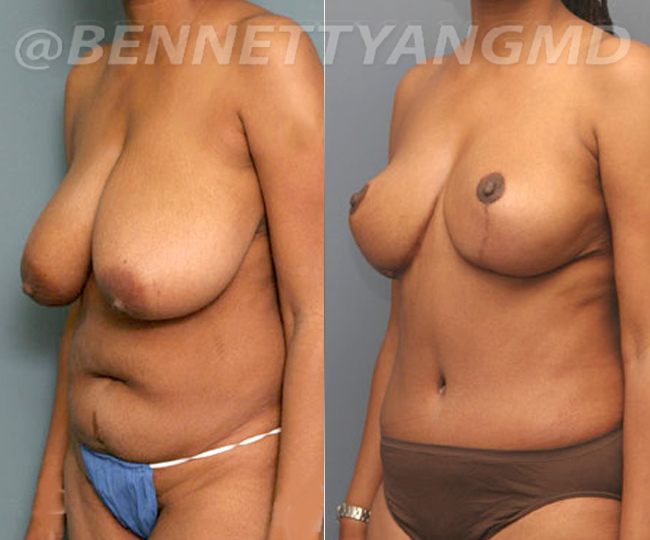 Breast Reduction Patient Before & After Images - Maryland Breast Surgeon
