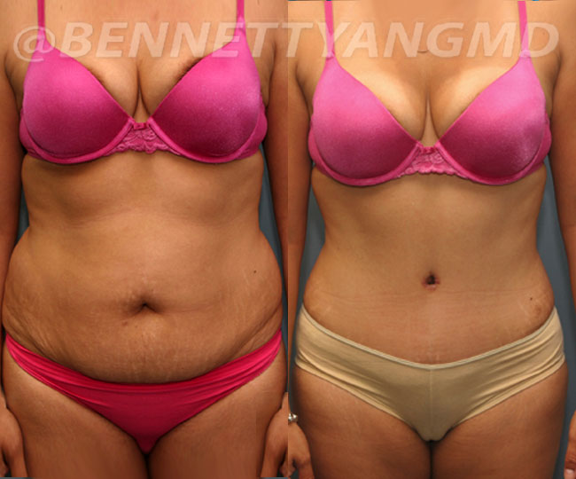 Before and After Liposuction Gallery