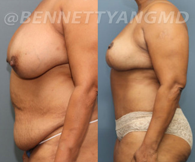 yang-mommy-makeover-patient3-before-after-front-left