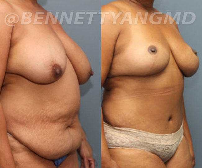 yang-mommy-makeover-patient3-before-after-front-right
