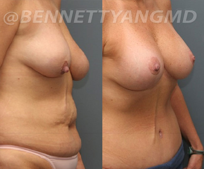 BBL Maryland Plastic Surgeon Bennett C. Yang