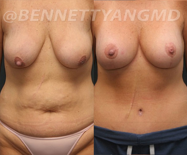yang-mommy-makeover-patient4-before-after-front