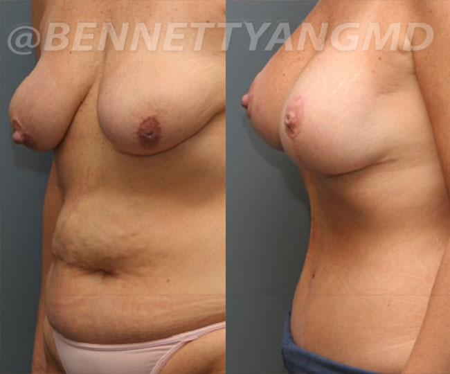 yang-mommy-makeover-patient4-before-after-left