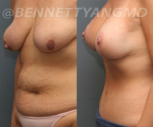 BBL Maryland Plastic Surgeon Bennett C. Yang