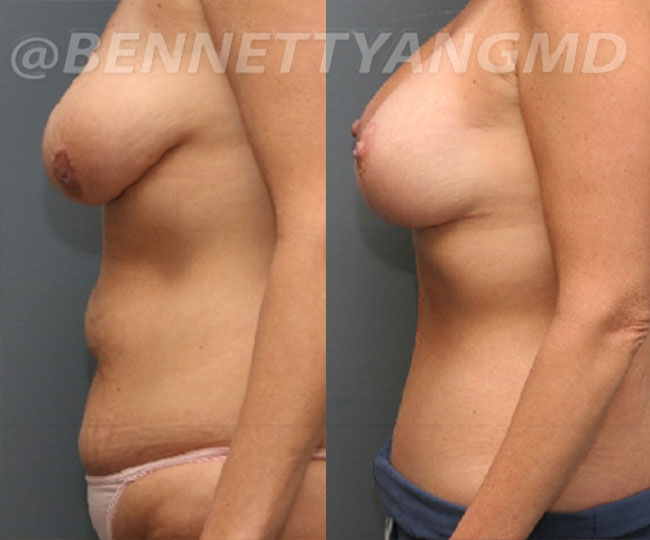 BBL Maryland Plastic Surgeon Bennett C. Yang