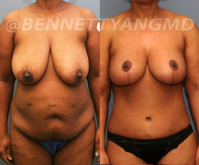 Breast Lift Patient Before & After Images - Maryland Breast Surgeon