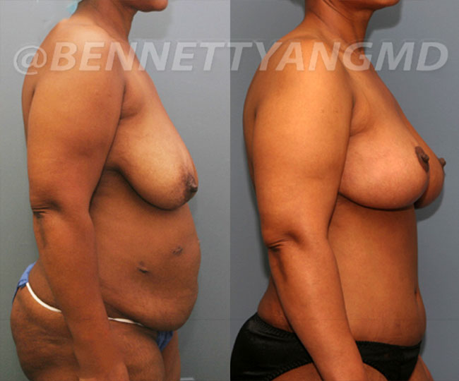 BBL Maryland Plastic Surgeon Bennett C. Yang