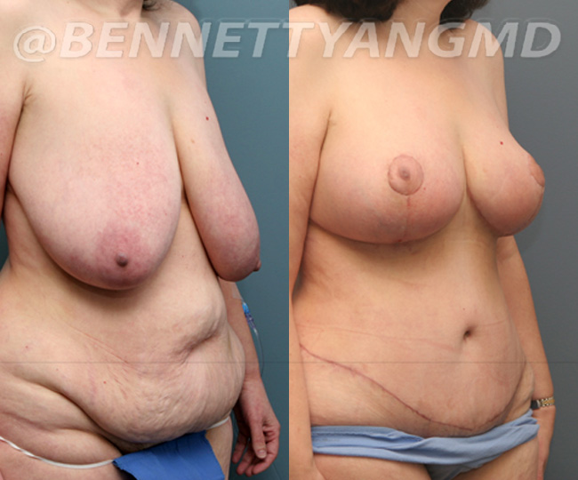 Breast Lift Patient Before & After Images - Maryland Breast Surgeon