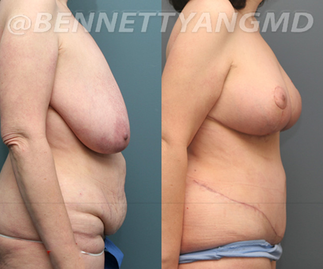 Breast Lift Patient Before & After Images - Maryland Breast Surgeon