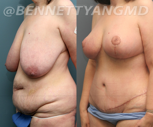 Breast Lift Patient Before & After Images - Maryland Breast Surgeon