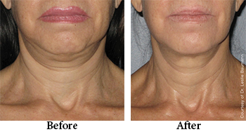 black friday promo $300 off neck skin tightening black friday special