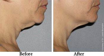 black friday promo $300 off neck skin tightening black friday special