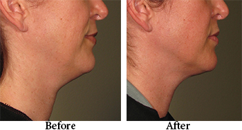 black friday promo $300 off neck skin tightening black friday special