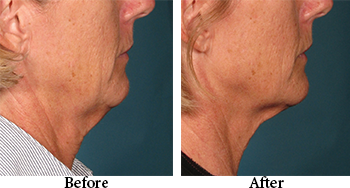 black friday promo $300 off neck skin tightening black friday special