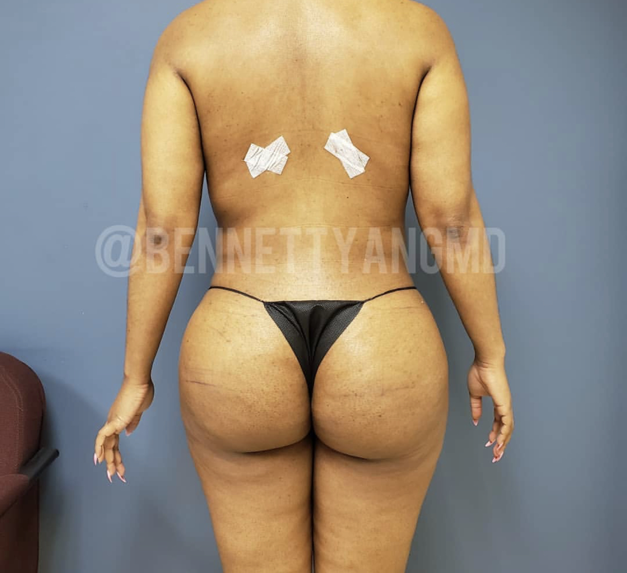 DMV BBL Plastic Surgeon, Brazilian Butt Lift Top Surgeon Maryland