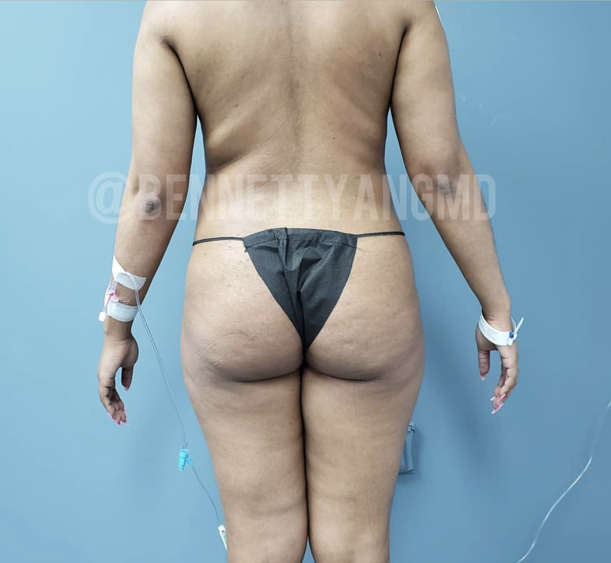 DMV BBL Plastic Surgeon, Brazilian Butt Lift Top Surgeon Maryland