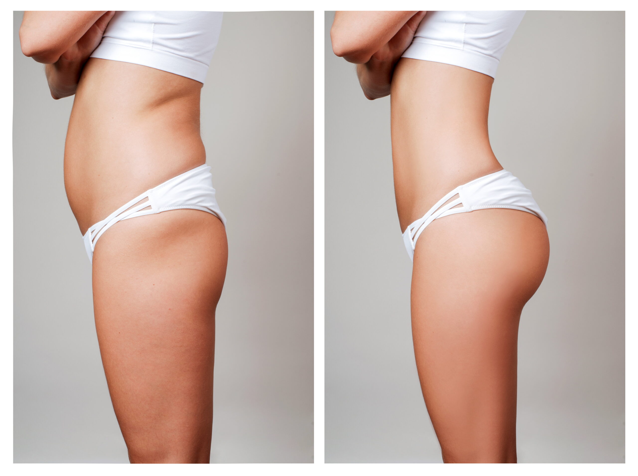 DMV BBL Plastic Surgeon, Brazilian Butt Lift Top Surgeon Maryland