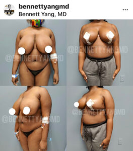Dr. Bennett C. Yang, offering Free Brazilian Butt Lift Virtual Consult text 301.284.8122