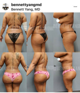 BBL with VASER LIPO 360 Before After snatched waist