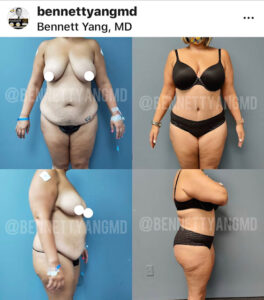 BBL with LIPO 360 Before After snatched waist