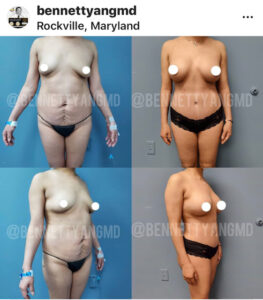 DMV BBL Plastic Surgeon, Brazilian Butt Lift Top Surgeon Maryland