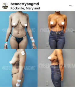 Breast Surgery Before After Photos Breast Reduction Medical Insurance Reimbursement Maryland