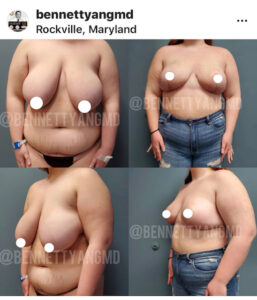 Tummy Tuck 360 DMV - Tummy Tuck Rockville, MD