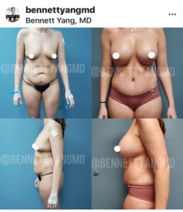 Bennett C. Yang, MD Maryland BBL Surgeon - Before After Images