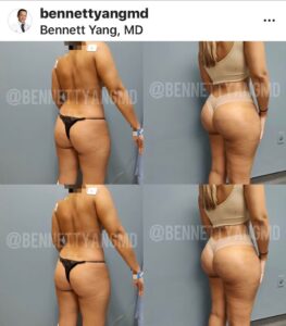 BBL with LIPO 360 Before After snatched waist