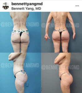 Dr. Bennett C. Yang, offering Free Brazilian Butt Lift Virtual Consult text 301.284.8122