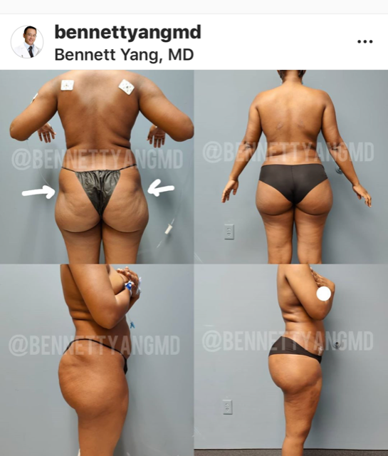 BBL Maryland- Brazilian Butt Lift, Hip Dip Correction