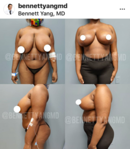 Breast Reduction Rockville Maryland Medical Insurance Reimbursement Maryland