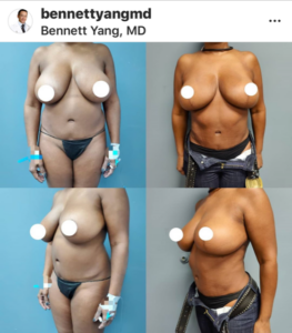 Snatched Waist BBL Lipo360 New Year Plastic Surgery Special