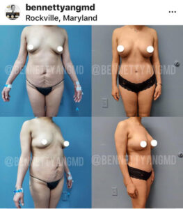 Breast Reduction Medical Insurance Reimbursement Maryland