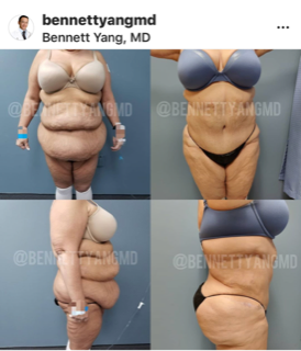 BBL with LIPO 360 Before After snatched waist