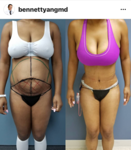 $254 /m BBL - snatched - LIPO360 Payment Plan
