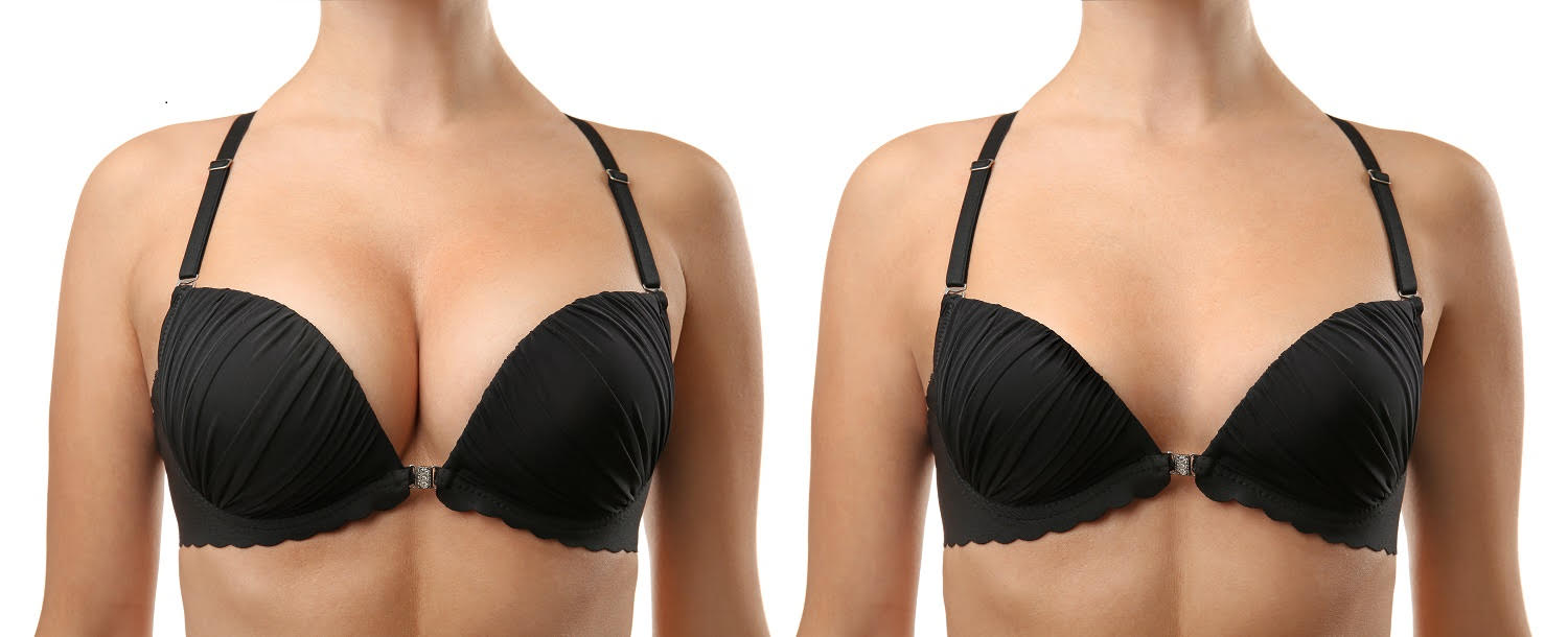 $142 /mo Breast Augmentation / Implants Maryland