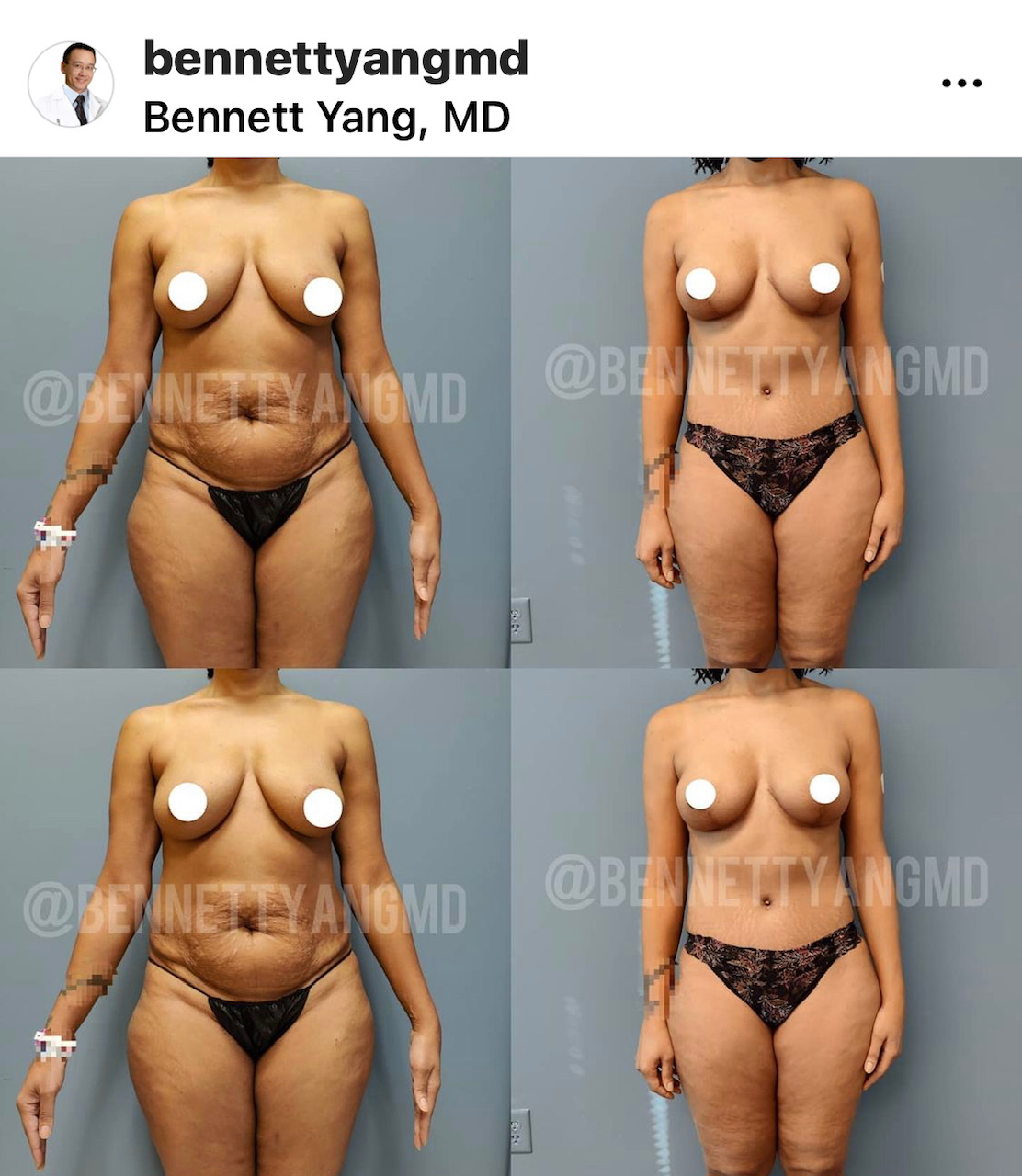 LIPO360 - Snatched Waist Surgery Washington DC